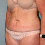 Tummy Tuck