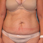 Tummy Tuck