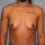 Breast Augmentation