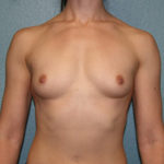 Breast Augmentation