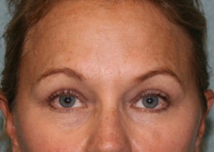 Eyelid Surgery