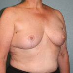 Breast Asymmetry Correction