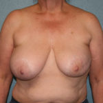 Breast Asymmetry Correction