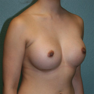 Breast Augmentation