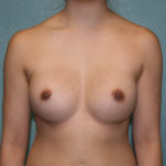 Breast Augmentation