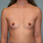 Breast Augmentation