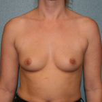 Breast Augmentation