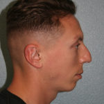 Nose Surgery (Rhinoplasty)