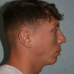Nose Surgery (Rhinoplasty)
