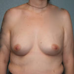 Gummy Bear Breast Implants