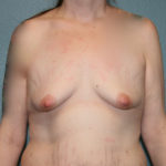 Gummy Bear Breast Implants