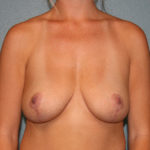 Breast Implant Removal