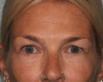 Eyelid Surgery