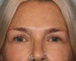 Eyelid Surgery
