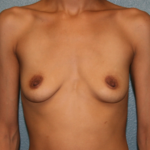 Gummy Bear Breast Implants