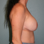 Breast Implant Removal