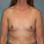 Breast Augmentation
