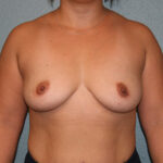 Breast Implant Removal