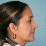 Nose Surgery (Rhinoplasty)