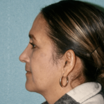 Nose Surgery (Rhinoplasty)
