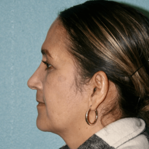 Nose Surgery (Rhinoplasty)