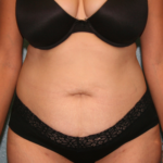 Tummy Tuck
