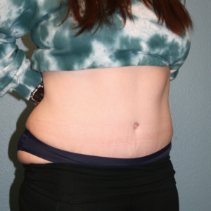 Tummy Tuck