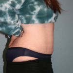 Tummy Tuck