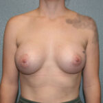 Breast Augmentation