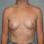 Breast Augmentation