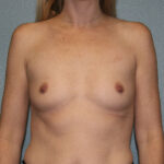 Breast Augmentation