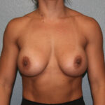 Breast Augmentation