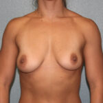 Breast Augmentation