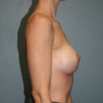 Breast Augmentation