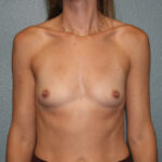 Breast Augmentation