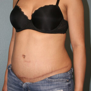 Tummy Tuck