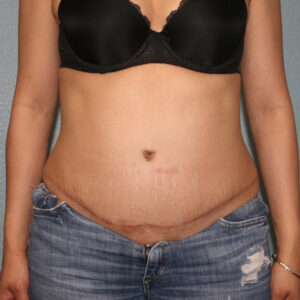 Tummy Tuck