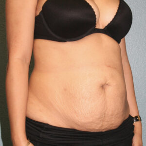 Tummy Tuck