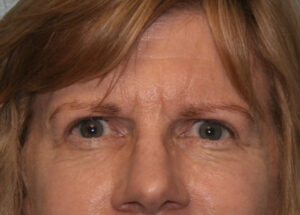 Eyelid Surgery