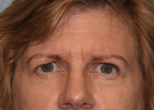 Eyelid Surgery