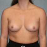 Breast Augmentation