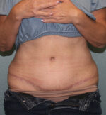 Tummy Tuck
