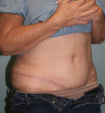 Tummy Tuck