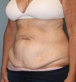 Tummy Tuck