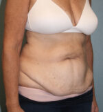 Tummy Tuck