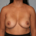 Breast Implant Removal