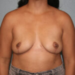 Breast Implant Removal