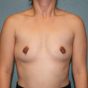 Breast Augmentation