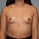 Breast Augmentation