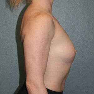 Breast Augmentation